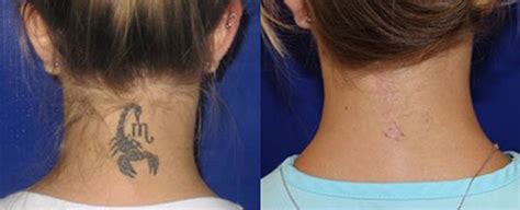 Say Goodbye to Regrettable Ink with Tattoo Removal in Santa Barbara